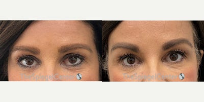 Brow Lift before and after photo