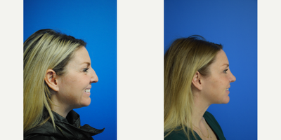 Chin Liposuction before and after photo