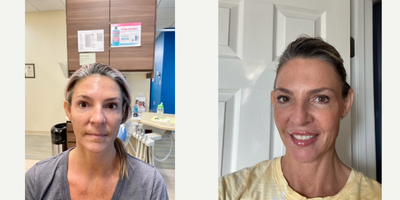 Dermal Fillers before and after photo