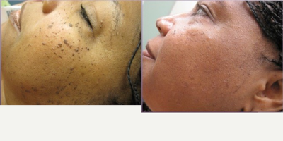 Laser Resurfacing before and after photo