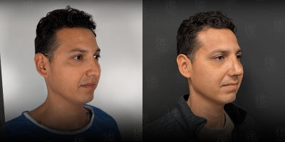 Rhinoplasty before and after photo