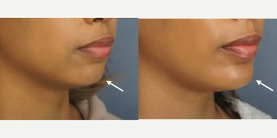 Chin Implant before and after photo