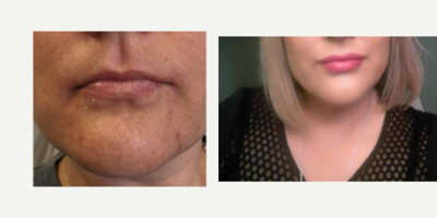 Lip Fillers before and after photo
