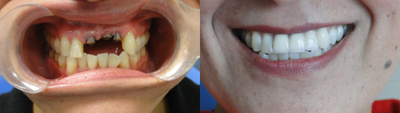 Dental Implants before and after photo