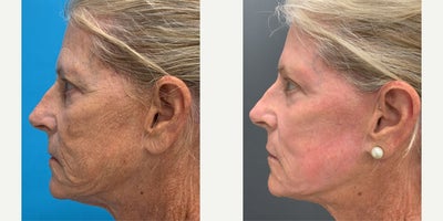Laser Resurfacing before and after photo