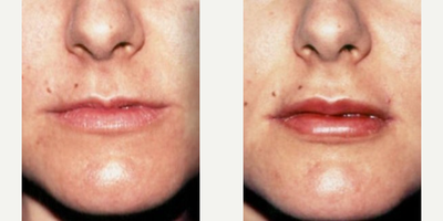 Lip Fillers before and after photo