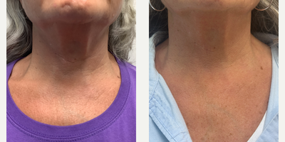 Morpheus8 before and after photo