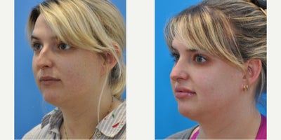 Rhinoplasty before and after photo