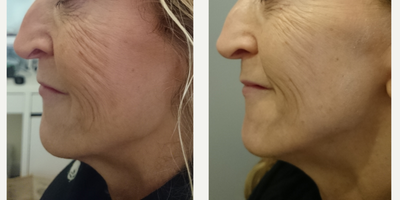 Chemical Peel before and after photo