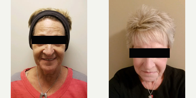 CO2 Laser before and after photo