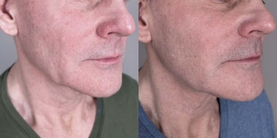 before and after image