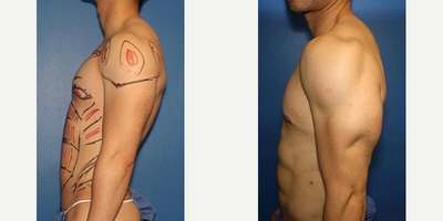 Bicep Implants before and after photo