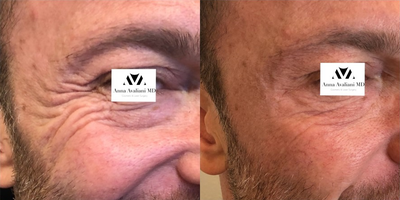 Botox before and after photo