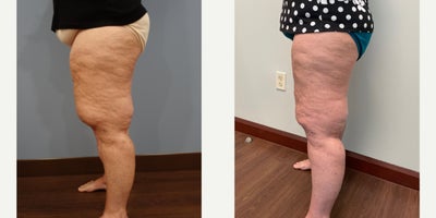 Liposuction before and after photo