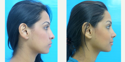 Rhinoplasty before and after photo