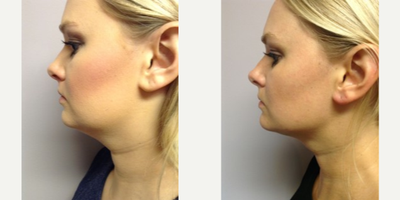 Skin Rejuvenation before and after photo