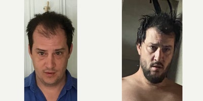 Hair Transplant before and after photo