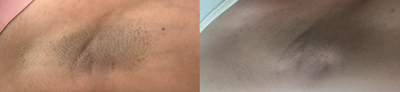 Laser Hair Removal before and after photo