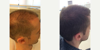PRP for Hair Loss before and after photo
