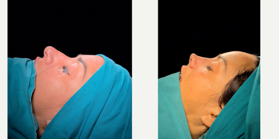 Rhinoplasty before and after photo