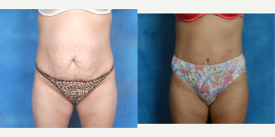 Tummy Tuck before and after photo