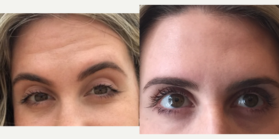 Botox before and after photo