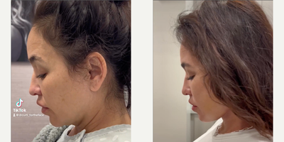 Deep Plane Facelift before and after photo