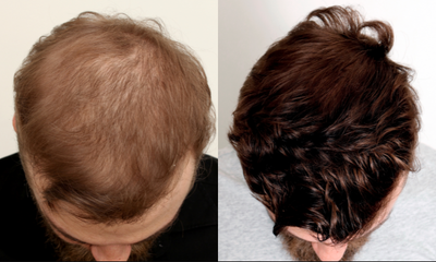 PRP for Hair Loss before and after photo