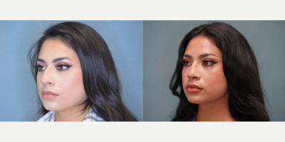 Rhinoplasty before and after photo