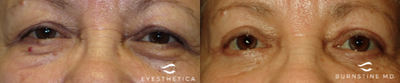 Brow Lift before and after photo