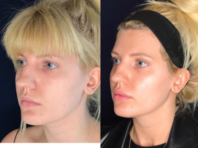 Dermal Fillers before and after photo