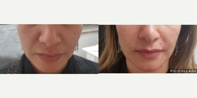 Dermal Fillers before and after photo