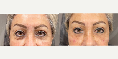 Dermal Fillers before and after photo