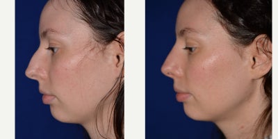 Rhinoplasty before and after photo