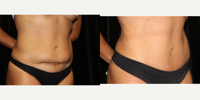 Tummy Tuck before and after photo