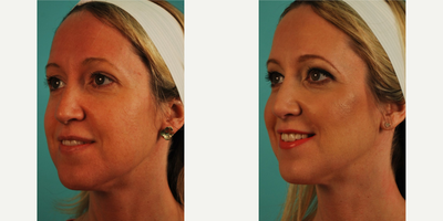 Voluma before and after photo