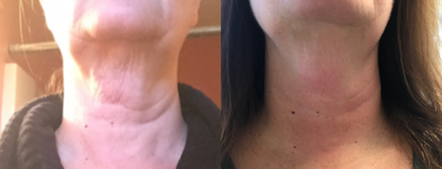 Exilis before and after photo