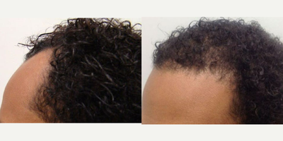 NeoGraft before and after photo