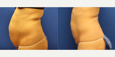 Smart Lipo before and after photo