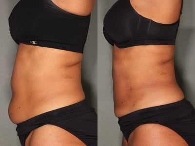 Vaser Liposuction before and after photo