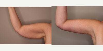 Arm Lift before and after photo