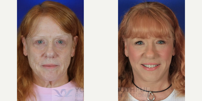 Eyelid Surgery before and after photo