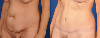 Tummy Tuck before and after photo