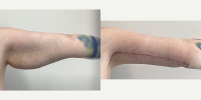 Arm Lift before and after photo