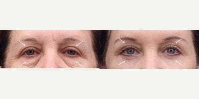 Eyelid Surgery before and after photo