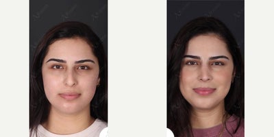 Rhinoplasty before and after photo