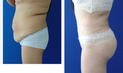 Tummy Tuck before and after photo
