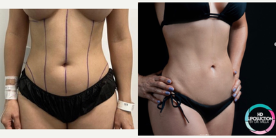 Vaser Liposuction before and after photo