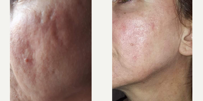 Chemical Peel before and after photo