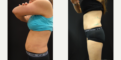 CoolSculpting before and after photo